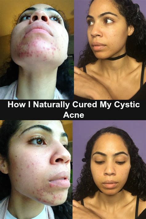 How I Naturally Cured My Hormonal Cystic Acne Remove Dairy Heal The