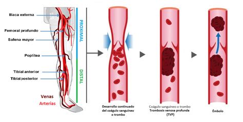 Trombosis venosa profunda Qué es causas síntomas tratamiento y