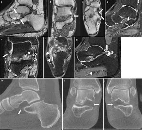 Subtalar Joint Middle Facet Agenesis In A 45 Year Old Woman Ag Mri Of