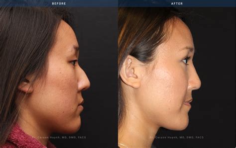 Complete Guide To Rhinoplasty Surgery Discover Radiance