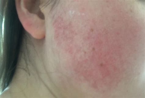 Skin Concern Ive Had This Red Mark On My Face For As Long As I Can