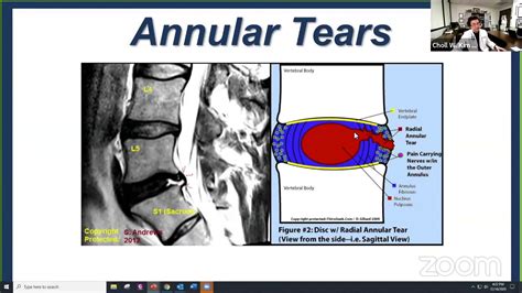 Annular Tears And Nagging Low Back Pain The Patients Perspective