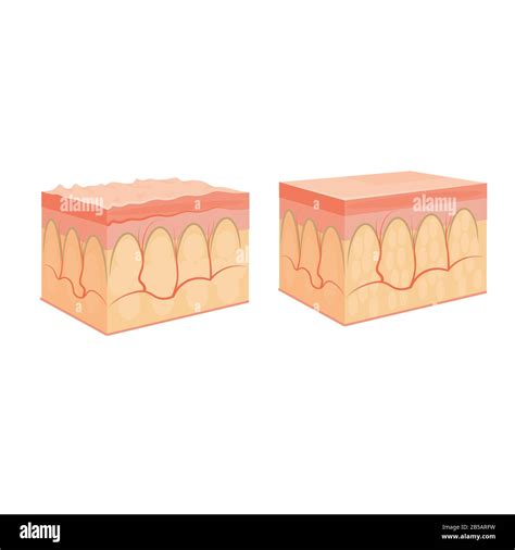 Wrinkle And Normal Skin Cross Section Of Human Skin Layers Structure