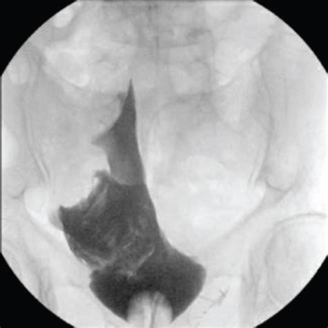 The Intraoperative Use Of A Portable Cone Beam Computed Tomography