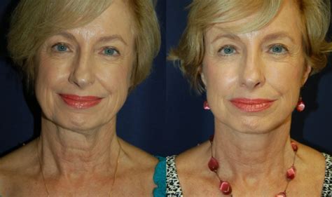 Facelift Procedure Before And After Photos Of Complete Facial Rejuvenation