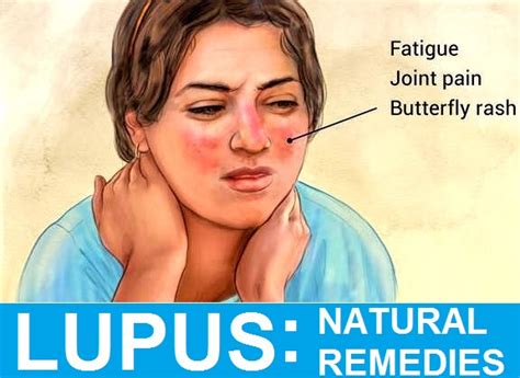 13 Best Natural Lupus Treatment And Remedies With Diet