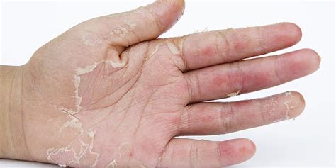It definitely gets rid of more dead skin that an aesthetician could, like in between your toes and the skin on the top of your foot. Home remedy to get rid of hand skin peeling | Home ...