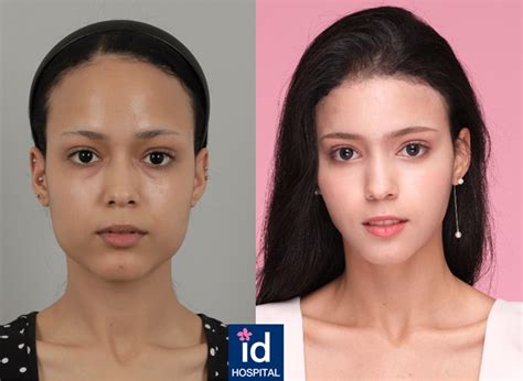 Top 5 Dramatic Plastic Surgery Results In Korea Idhospital