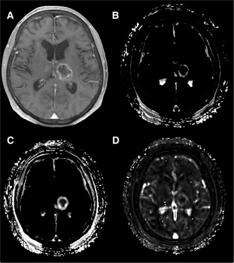 Diagnosis Of Brain Tumors Using Dynamic Contrast Enhanced Perfusion