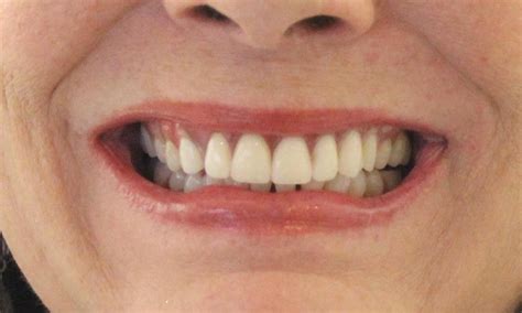 Smile Gallery Partial Dentures To Close Gap In Teeth Dentist