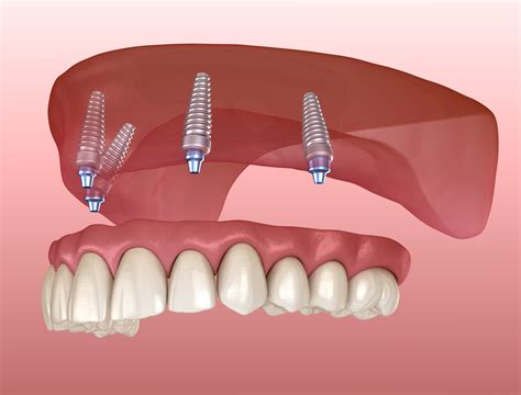 Dental Implants Laguna Niguel Ca Replace Missing Teeth
