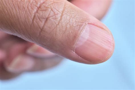 Have Ridges On Your Fingernails This Is What They Meanratemds Health News