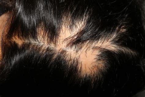 Pin On Hair Loss