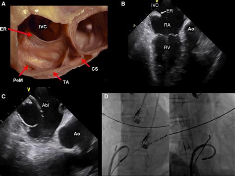 Use Of Intracardiac Echocardiography In Interventional Cardiology