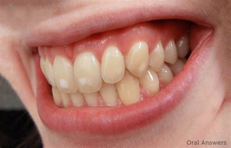 Dental Fluorosis Treatment How Dental Fluorosis Is Treated Oral Answers