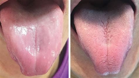 Bizarre Photo Shows Mans Smooth Tongue After His Taste Buds Disappear