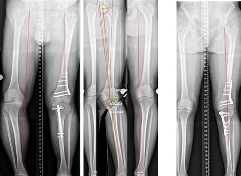Osteotomy Surgery Knee Surgery Northern Knee Clinic