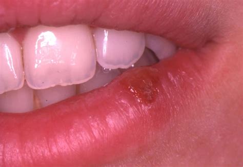 But the repeated outbreaks tend to be shorter and less severe each time you. Herpes Simplex Virus (Hsv) Infection Of The Mouth ...