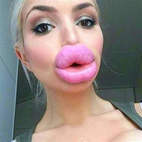 Bad Plastic Surgeries Plastic Surgery Gone Wrong Fake Lips Big Lips