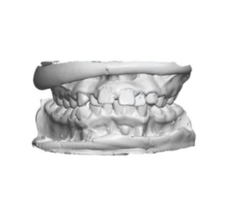 3d Printed And Digital Dental Study Models Orthoselect