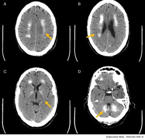 Through the use of ct scans, calcifications are seen primarily in the basal ganglia and in other areas such a. Hipocalcemia grave y deterioro cognitivo en paciente con ...