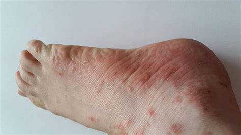 Bệnh tổ đỉa ở ngón chân Dấu hiệu nhận biết và cách điều trị Vinmec