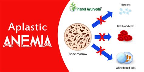 What Are The Causes Symptoms And Treatment Of Severe Aplastic Anemia