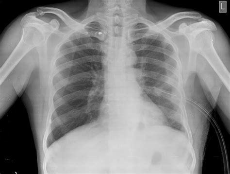 Chest Radiograph Wikipedia