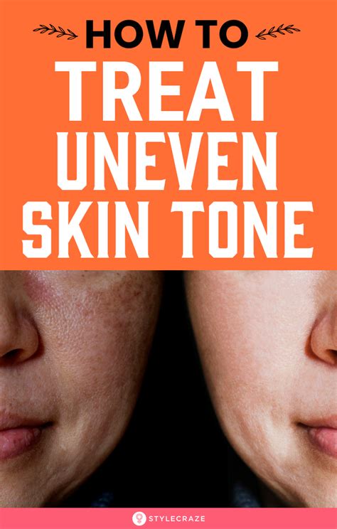 How To Treat Uneven Skin Tone What Most Of Us Do Is Cover Our Uneven