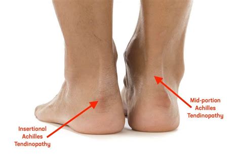 Quick Facts On Achilles Tendinitis Kinetic Labs Toronto Physiotherapy Chiropractic And