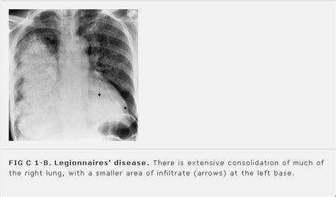 Выпускающий редактор — хуторной никита. Legionnaires' Disease blog