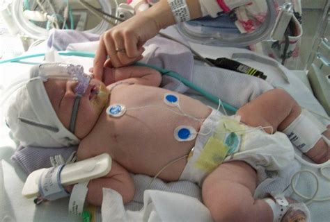 Neonatal Asphyxia Causes Symptoms Treatment Management And Care Of