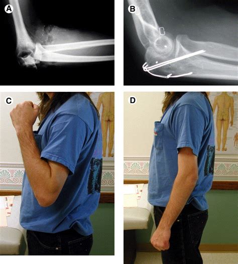 Fractures Of The Olecranon Journal Of The American Society For