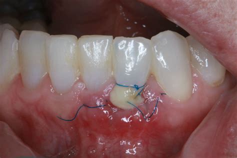 Gingival Gum Grafting Sugar Land Tx 77479 Smiles On Greatwood