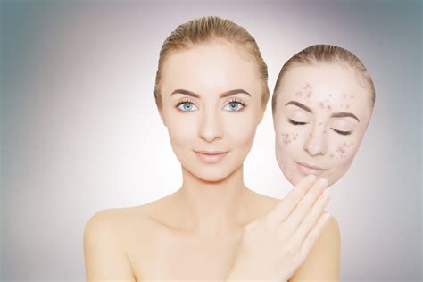 Menjaga kesehatan kulit, contohnya memerhatikan kebiasaan cuci muka. Noda Hitam Bekas Jerawat Susah Hilang? Ini 4 Cara yang ...