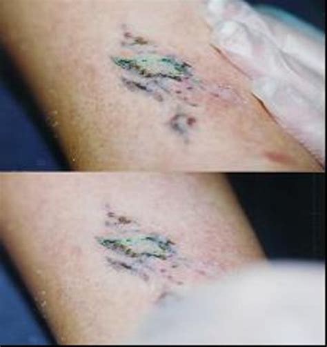 Monasebian deems to be appropriate, this is a very good alternative. Surgical Excision Tattoo Removal photos | Tattoo World ...
