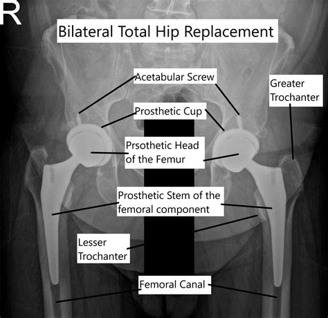 Bilateral Simultaneous Total Hip Replacement Complete Orthopedics