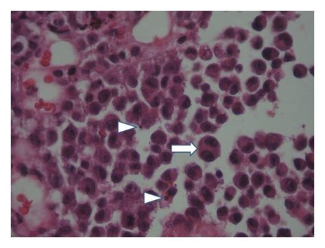 Neoplastic Cells Demonstrated Eosinophilic Cytoplasm And Eccentric