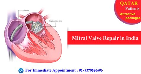 Attractive Packages For Qatar Patients For Mitral Valve Repair In India
