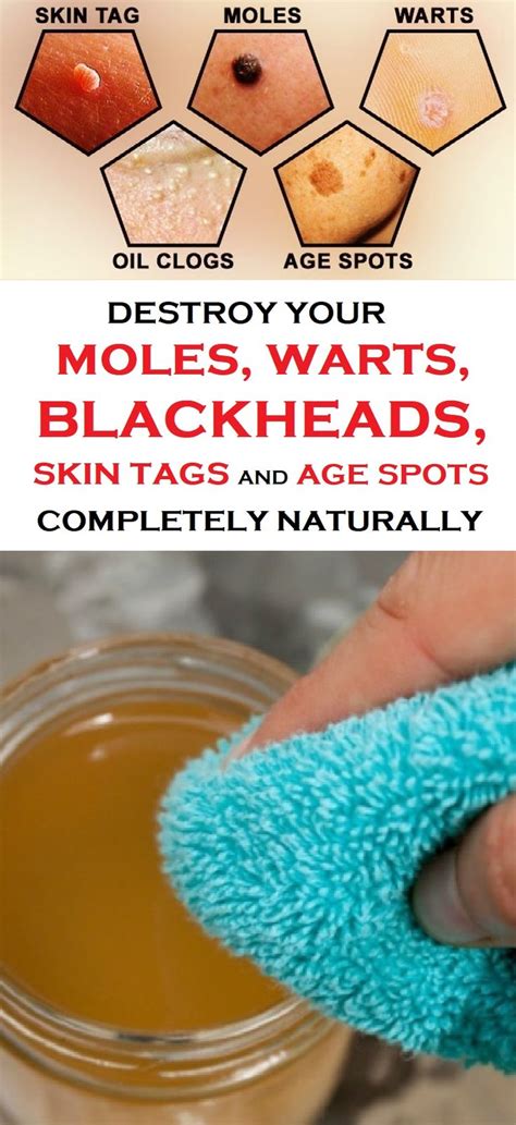 A skin tag is a small piece of soft, hanging skin that may have a peduncle, or stalk. Destroy Your Moles, Warts, Blackheads, Skin Tags And Age ...