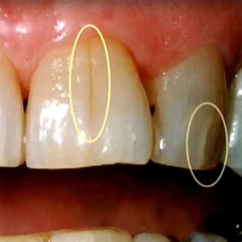 Hairline Cracks In Front Teeth - clevertemplates