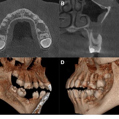 Panoramic Radiograph Showing An Impacted Left Maxillary Premolar With