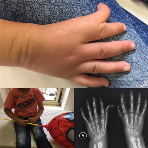 Malformação Dos Dedos Das Mãos