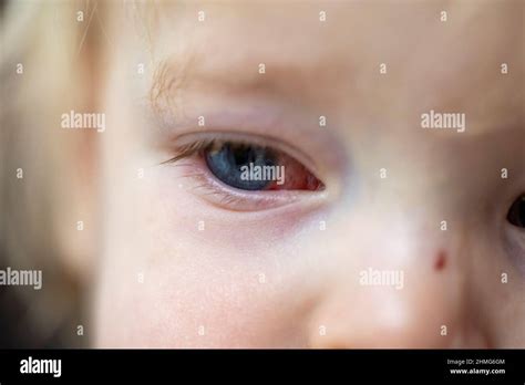 A Portrait Of An Infected Red Eye Of A Child With Conjunctivitis The