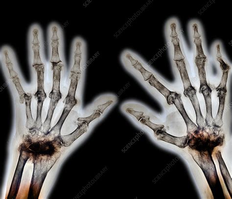 Arthritic Hands X Ray Stock Image M1100587 Science