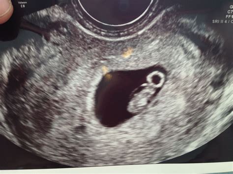 Ultrasound At 7 Weeks Pregnant