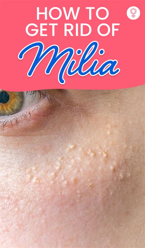 How To Get Rid Of Milia At Home Prevention Tips Artofit