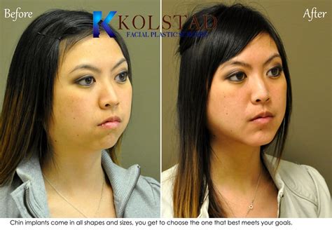 Asian Chin Augmentation Before And After Gallery Dr Kolstad San