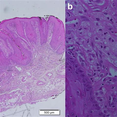 Histological Specimen Of Verruciform Xanthoma In The Hard Palate