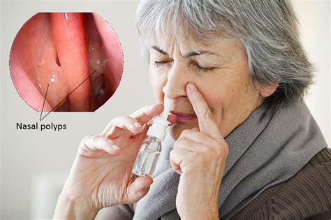Nasal Polyps Adelaide Ent Specialistsadelaide Ent Specialists